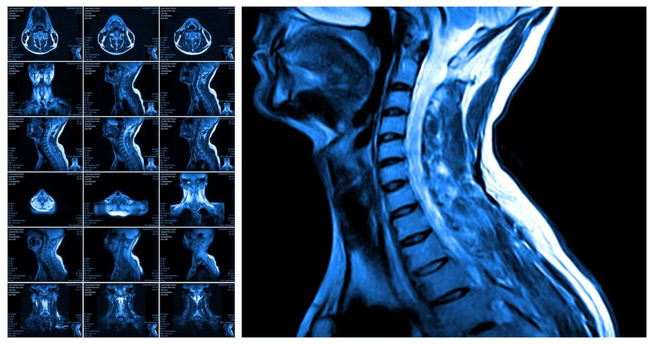 Kinematics of fast cervical rotations in persons with chronic neck pain: a cross-sectional and reliability study