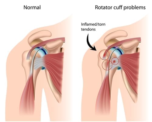 Restoring External Rotation in the Shoulder