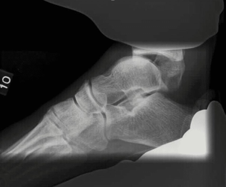 Fibular Malalignment in Individuals with Chronic Ankle Instability