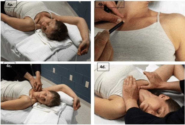 The prevalence of osteoarthritis of the sternoclavicular joint on computed tomography