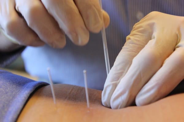 Dry Needling: A Modality to Treat Trigger Points