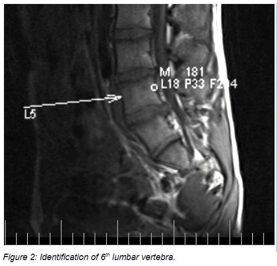 Hip-Waist Extension Stiffness Syndrome in an Adolescent with Lumbar Disc Protrusions: A Case Report