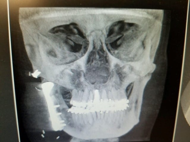 Temporomandibular Joint Arthroplasty, Physical Therapy and Motor Control Retraining: A Case Report