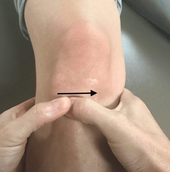 Tibiofemoral joint mobilization in the successful management of patellofemoral pain syndrome: A case report