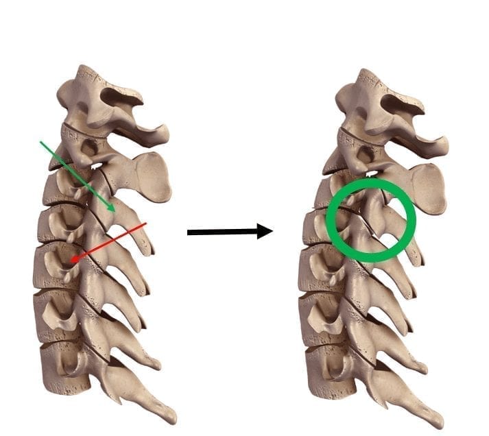 Immediate effects of cervical mobilisations on global perceived effect, movement associated pain and neck kinematics in patients with non-specific neck pain. A double-blind placebo randomized controlled trial