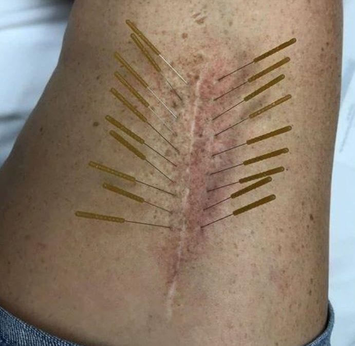 Deep Dry Needling May Be More Effective In Treating Spine-Related Pain Than Superficial Dry Needling – Systematic Review