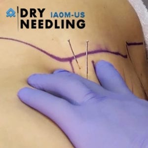 Dry Needling Level II with Cadaver Lab – Abilene TX – Apr 2025