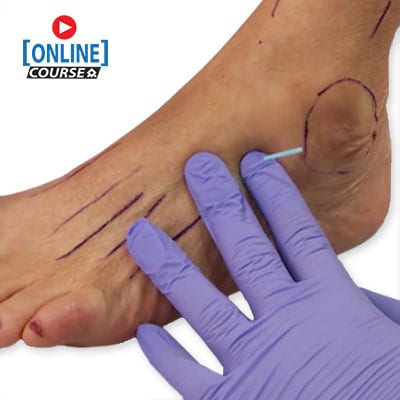 Dry Needling in Plantar Fasciitis Online website copy
