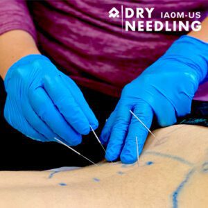 Dry Needling for the Basketball Athlete – Independence OH – Aug 2025